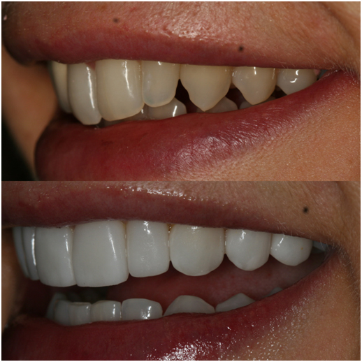 Before and After