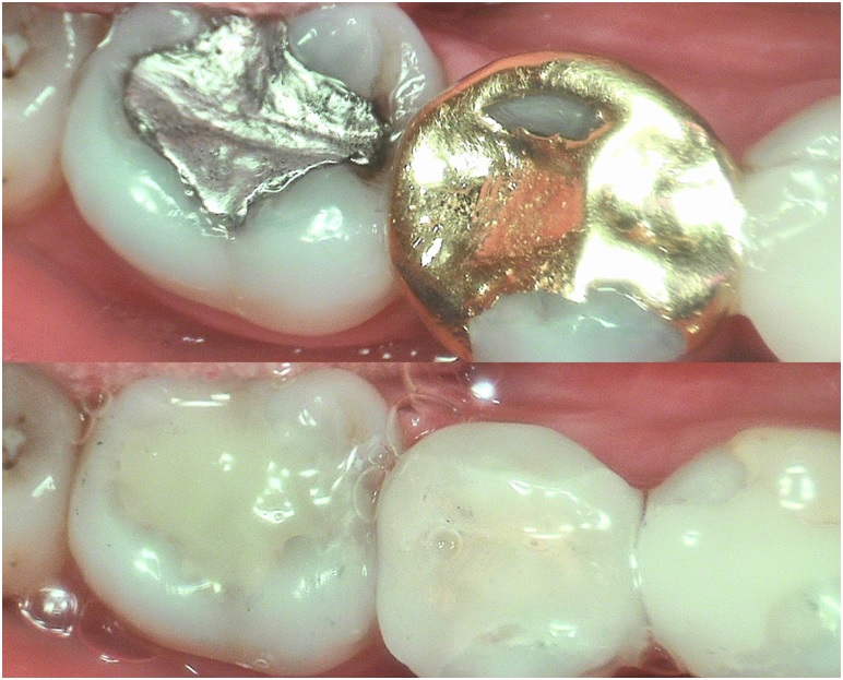 Composite Fillings