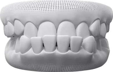 Overbite