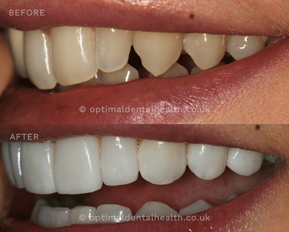 Porcelain veneers