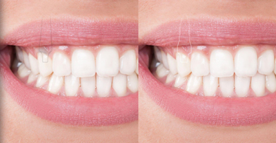 Gums Compared