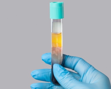 platelet-rich-fibrin