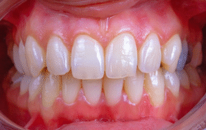 what are the signs of gum disease