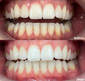 dental cleaning london tooth stain removal