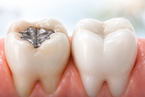 a diagram of a tooth with a mercury filling next to a restored tooth