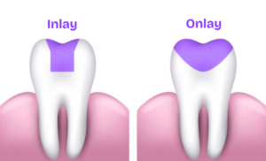 a diagram explaining the difference between a dental inlay and dental onlay