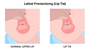 a diagram of a labial frenectomy