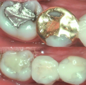 metal filling replacement in london