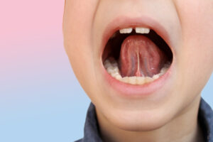 a childs mouth open showing a tongue tie