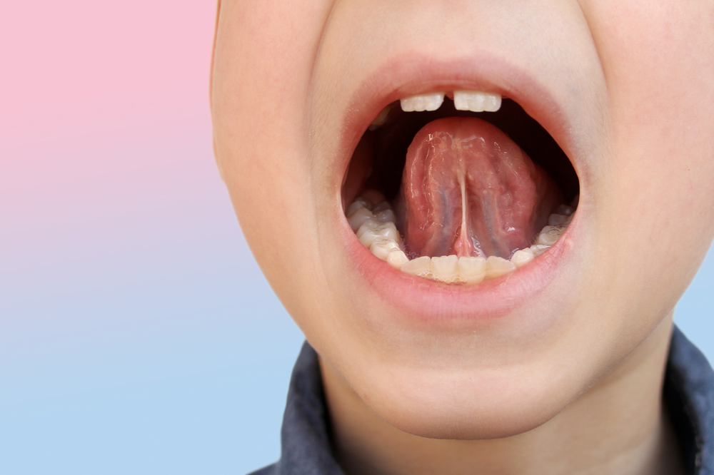 a childs mouth open showing a tongue tie