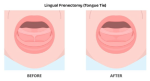a diagram of a lingual frenectomy