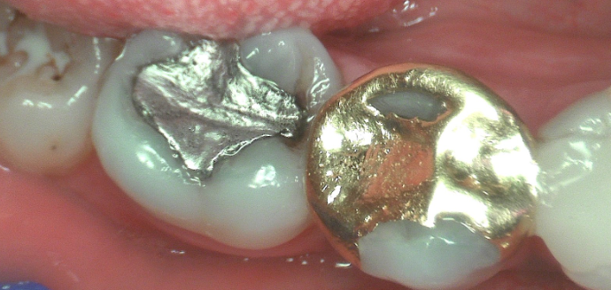 replace metal fillings in london