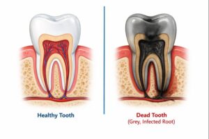 a diagram of a healthy tooth compared to a grey tooth that outlines causes and treatments 
