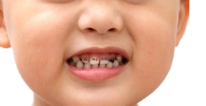 a close up of a childs face with their mouth open displaying signs of tooth decay