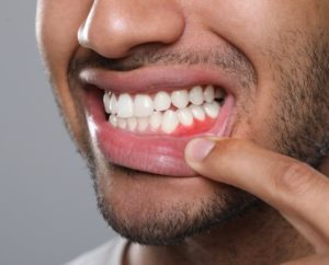 a stock image showing a close up of a mans teeth pointing to an inflamed part of his gum