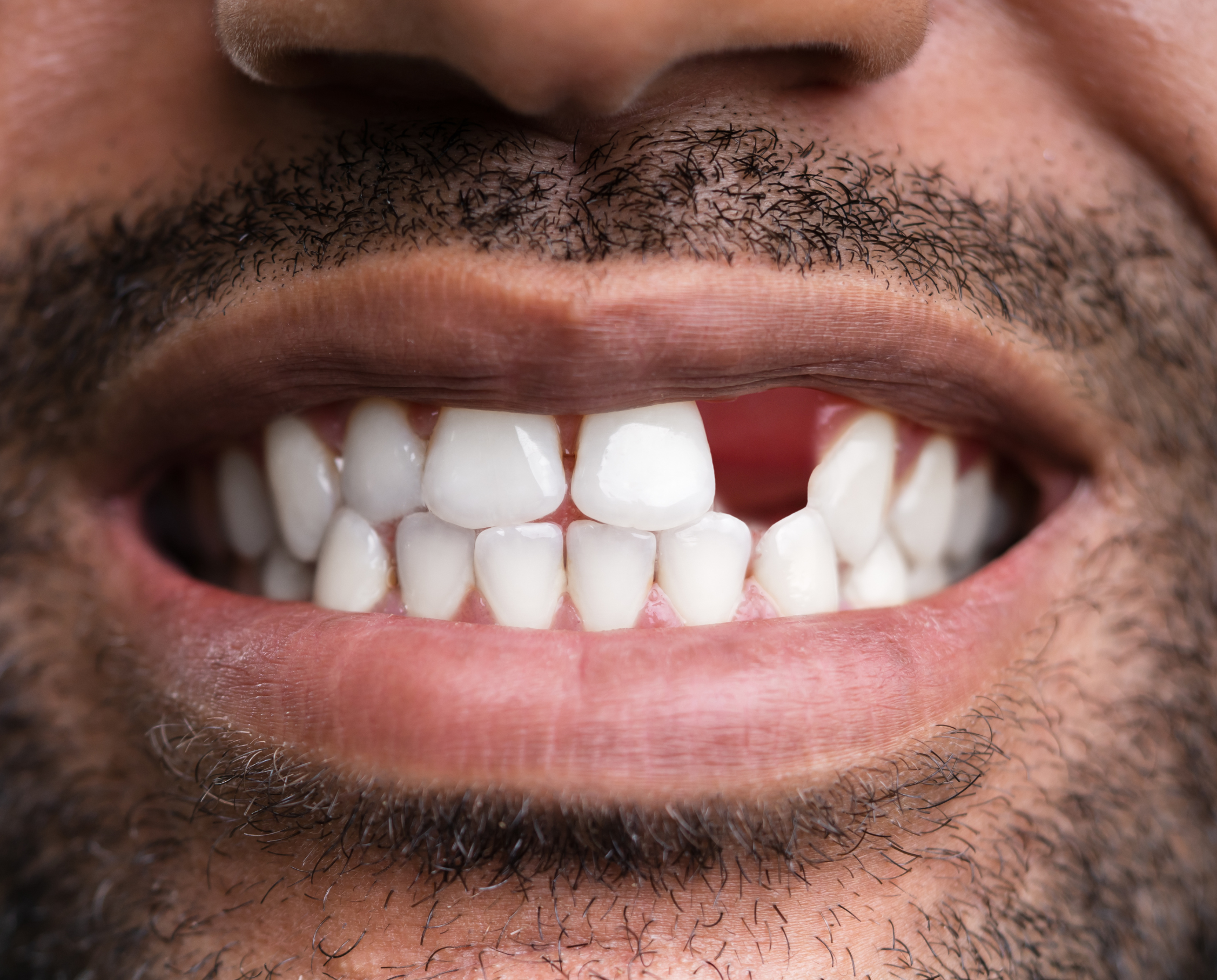 a close up image of a mans teeth with one missing to depict dental trauma and dental emergencies