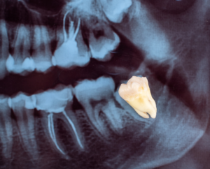 an image of a wisdom tooth being shown through a digital xray